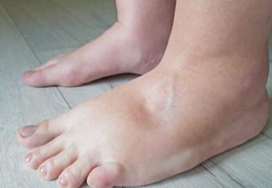 बार-बार पैरों में सूजन दिखना हो सकता है खतरे की घंटी, दिल की बीमारी का संकेत