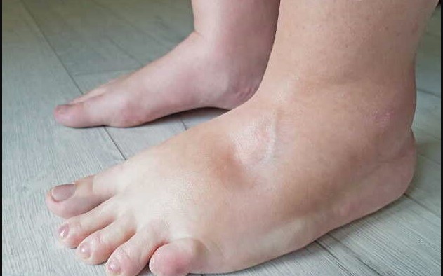 बार-बार पैरों में सूजन दिखना हो सकता है खतरे की घंटी, दिल की बीमारी का संकेत