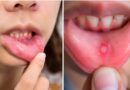 मुंह के छालों से तुरंत राहत चाहते हैं? आजमाएं ये असरदार घरेलू नुस्खे