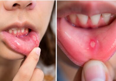 मुंह के छालों से तुरंत राहत चाहते हैं? आजमाएं ये असरदार घरेलू नुस्खे